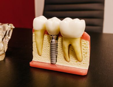 Ceramic dental implants with bolt in artificial mouth piece on desktop in hospital