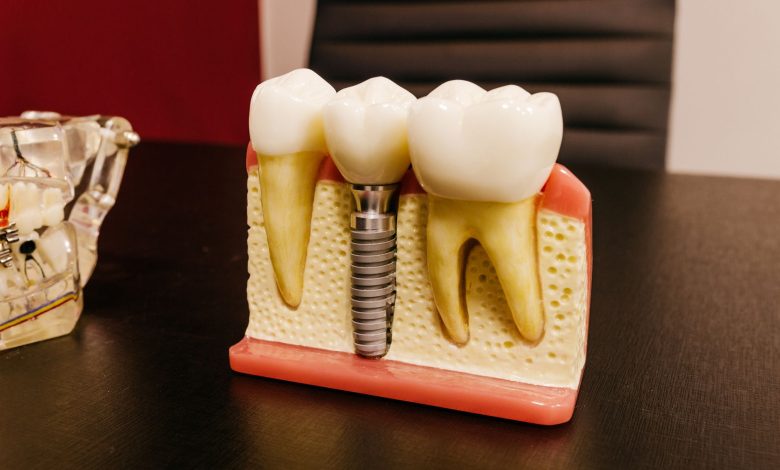 Ceramic dental implants with bolt in artificial mouth piece on desktop in hospital